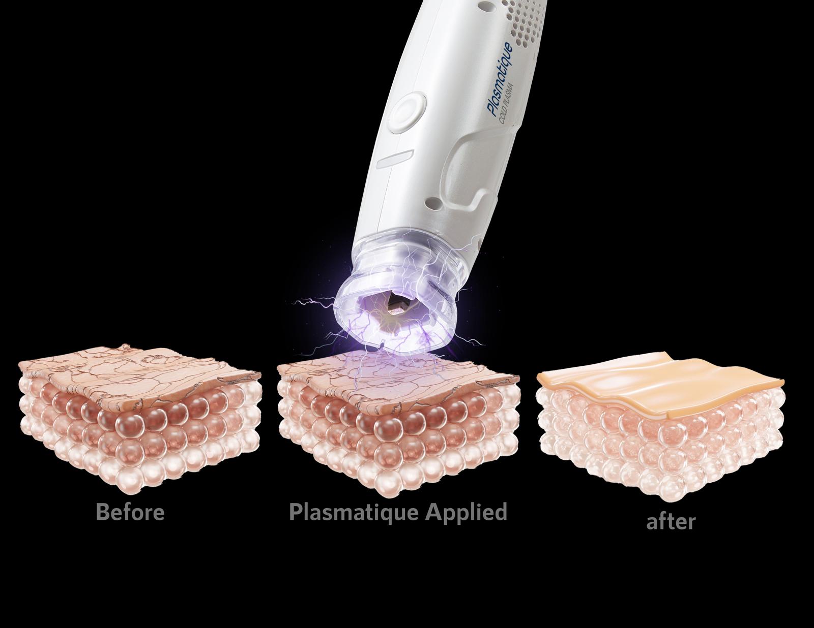 Fibroblast USA